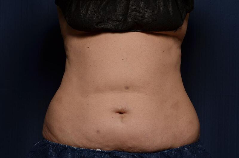 CoolSculpting Elite Before & After Image