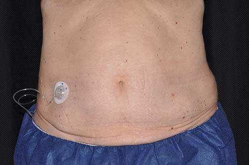 CoolSculpting Elite Before & After Image