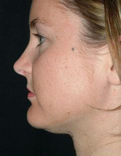 Chin & Neck Liposuction Before & After Image