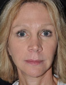 Facelift Before and After Pictures Palm Beach Gardens and Jupiter, FL