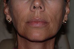 Facial Injectables Before and After Pictures Palm Beach Gardens and Jupiter, FL