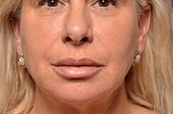 Facial Injectables Before and After Pictures Palm Beach Gardens and Jupiter, FL