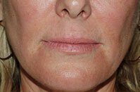 Lip Fillers Before and After Pictures Palm Beach Gardens and Jupiter, FL