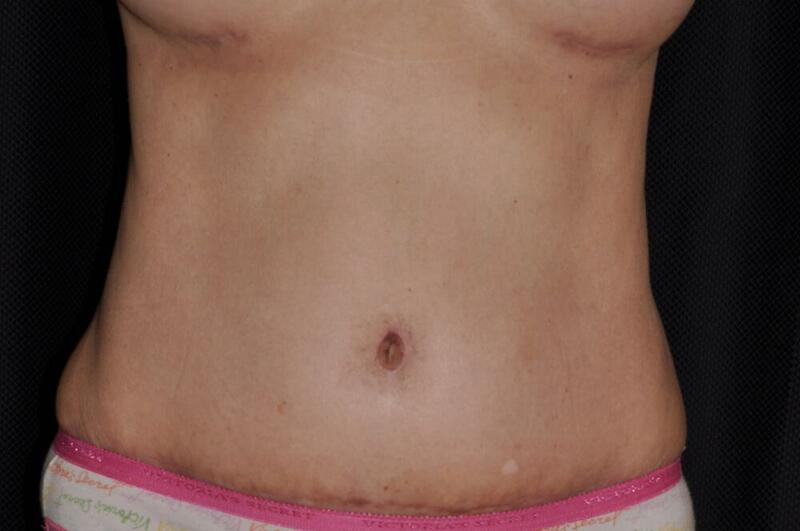 Abdominoplasty Before & After Image