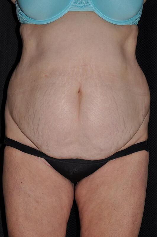 Abdominoplasty Before & After Image