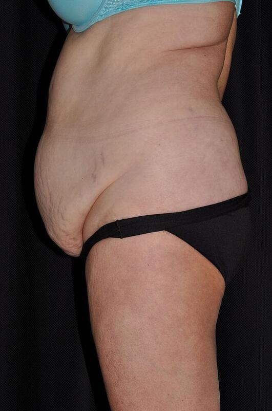 Abdominoplasty Before & After Image