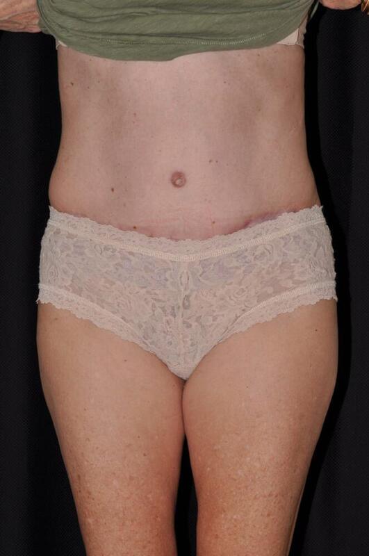 Abdominoplasty Before & After Image