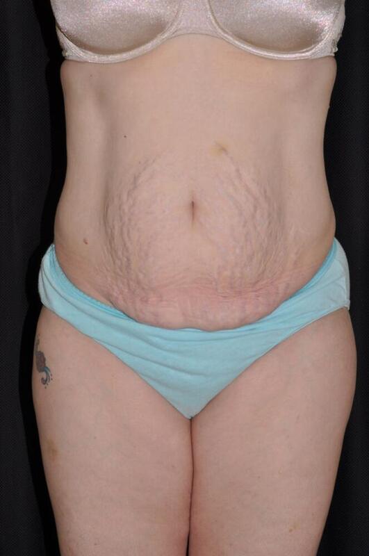 Abdominoplasty Before & After Image