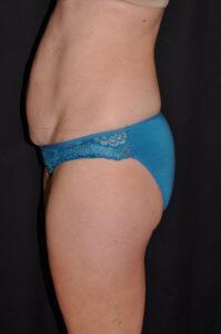 Abdominoplasty Before & After Image