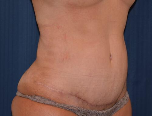 Abdominoplasty Before & After Image