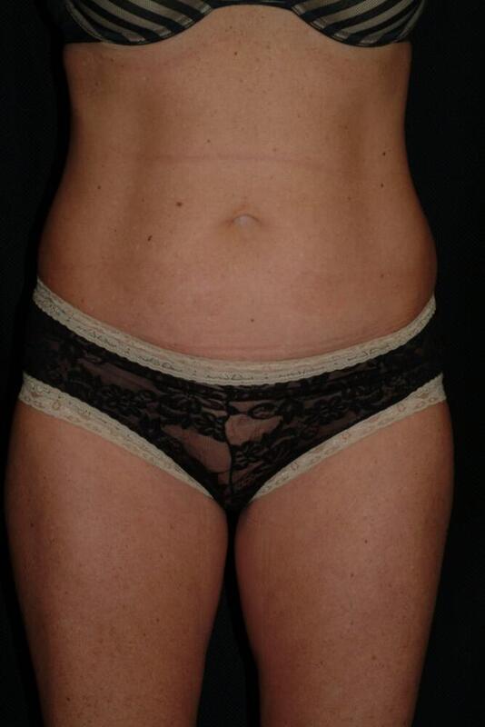 Abdominoplasty Before & After Image