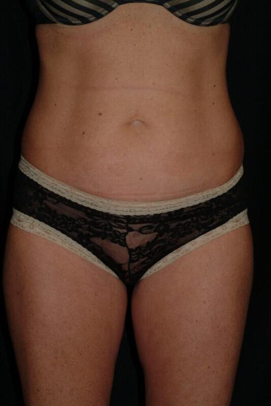 Abdominoplasty Before & After Image