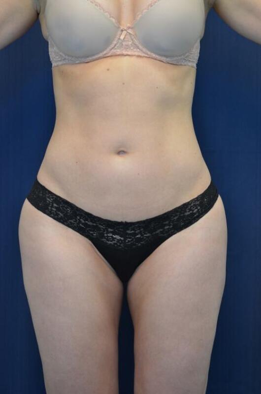 Body Lift Before & After Image