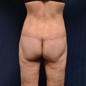 Body Lift Before & After Image