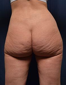 Brazilian Butt Lift Before & After Image