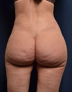 Brazilian Butt Lift Before & After Image