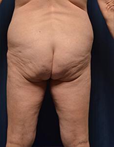 Brazilian Butt Lift Before & After Image