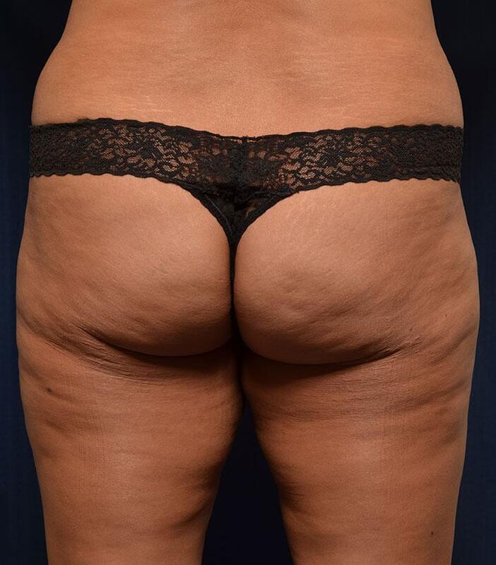 Brazilian Butt Lift Before & After Image