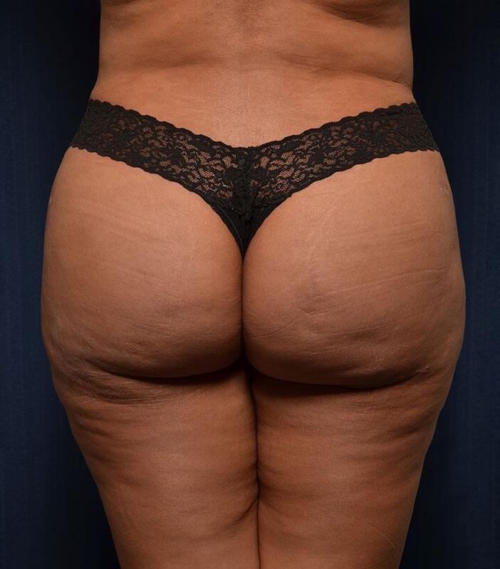 Brazilian Butt Lift Before & After Image