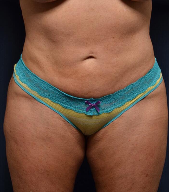 Brazilian Butt Lift Before & After Image