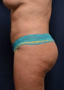 Brazilian Butt Lift Before & After Image