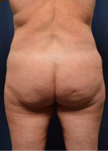 Brazilian Butt Lift Before & After Image