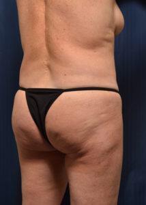 Brazilian Butt Lift Before & After Image