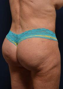 Brazilian Butt Lift Before & After Image