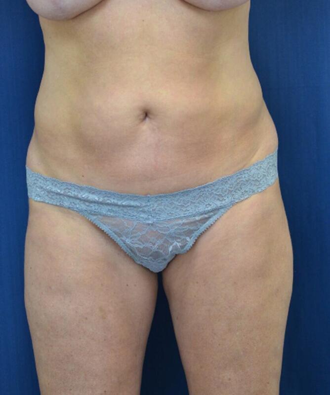 Brazilian Butt Lift Before & After Image