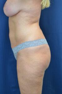 Brazilian Butt Lift Before & After Image