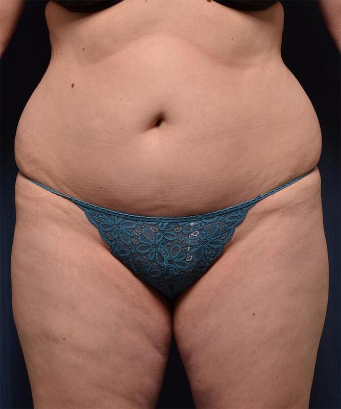 Brazilian Butt Lift Before & After Image