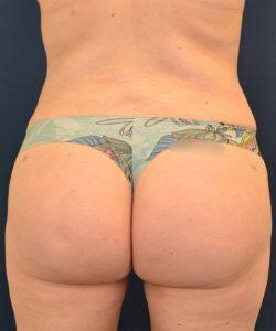 Brazilian Butt Lift Before & After Image