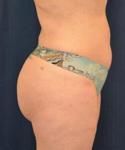 Brazilian Butt Lift Before & After Image