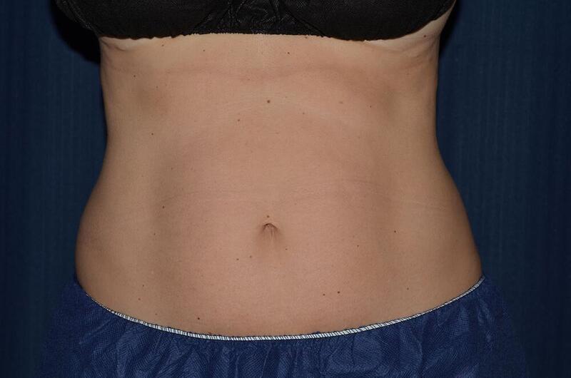 CoolSculpting Elite Before & After Image