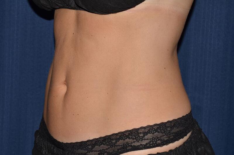 CoolSculpting Elite Before & After Image