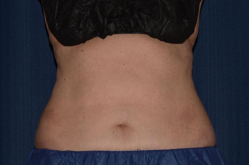 CoolSculpting Elite Before & After Image