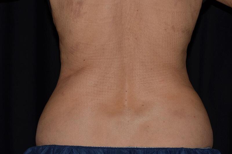 CoolSculpting Elite Before & After Image