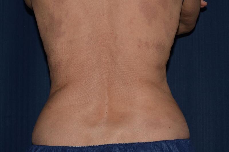 CoolSculpting Elite Before & After Image