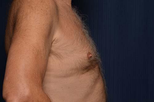 CoolSculpting Elite Before & After Image