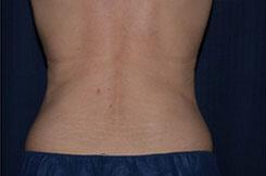 CoolSculpting Elite Before & After Image