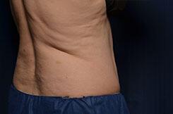 CoolSculpting Elite Before & After Image