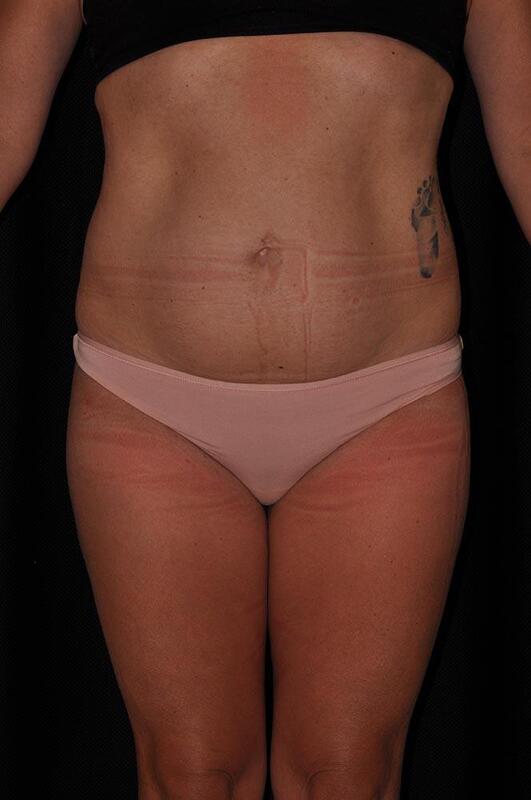 Liposuction Before & After Image