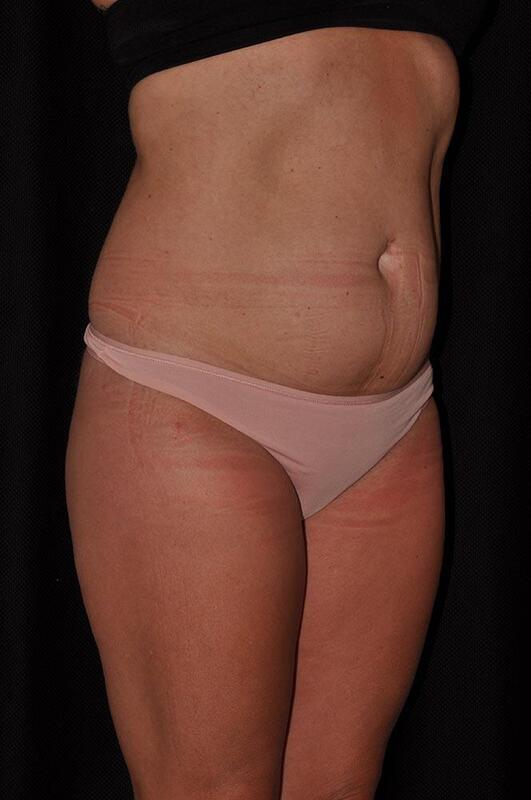 Liposuction Before & After Image