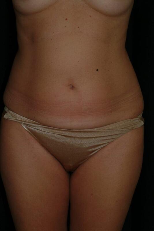 Liposuction Before & After Image