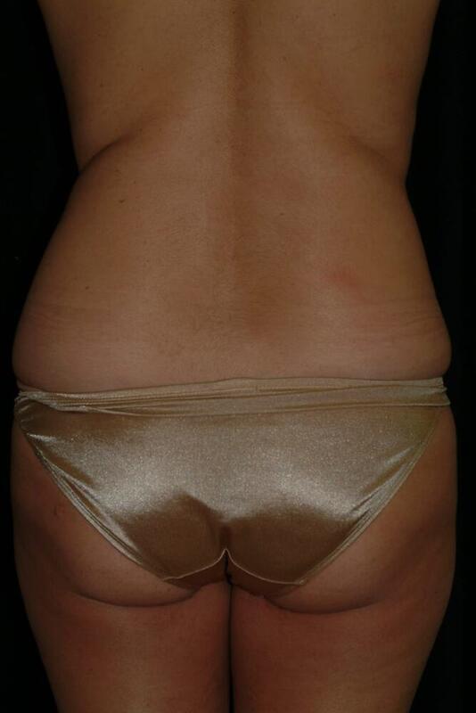 Liposuction Before & After Image