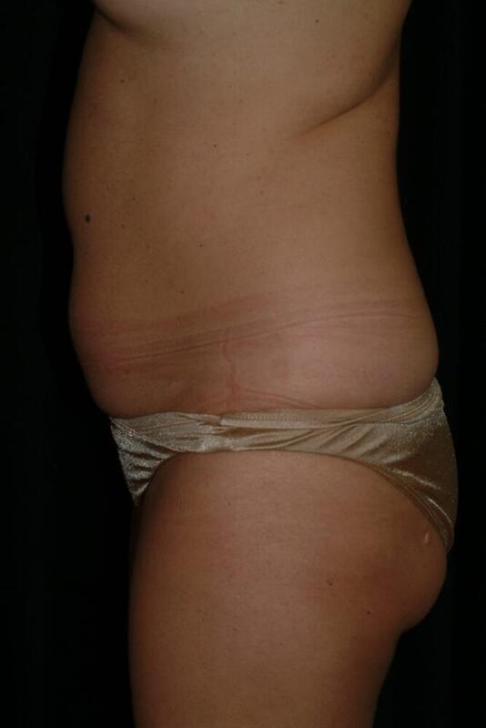 Liposuction Before & After Image