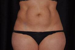 Liposuction Before & After Image