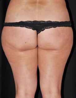 Liposuction Before & After Image