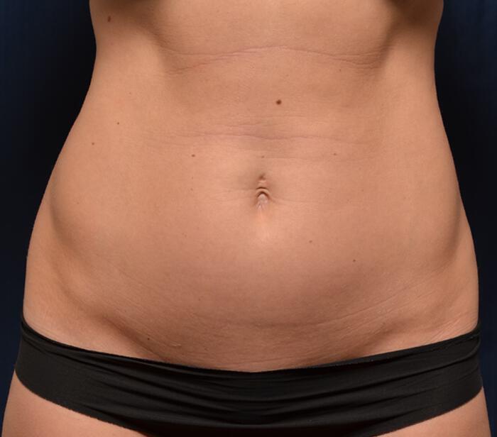 Liposuction Before & After Image