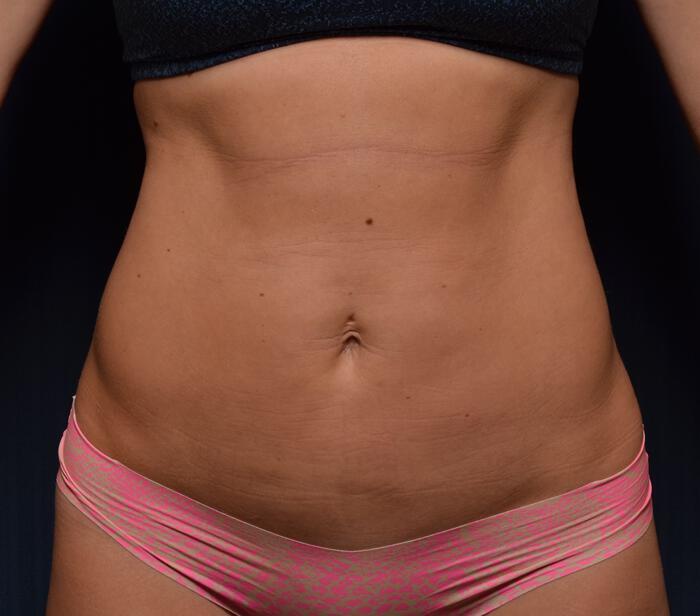 Liposuction Before & After Image